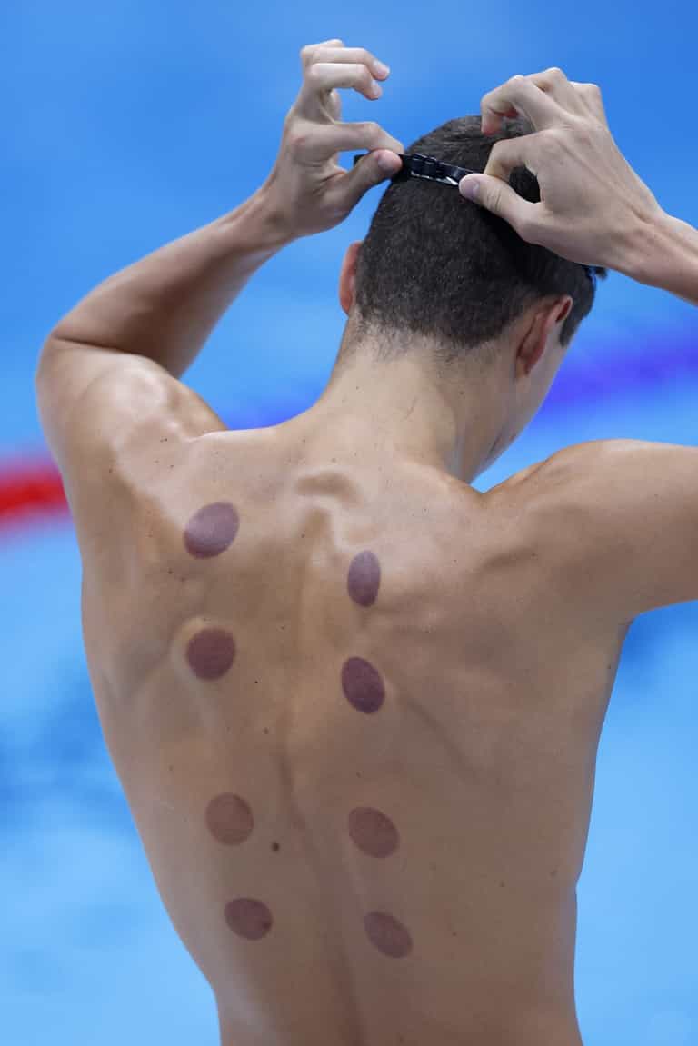What are the dark circles on swimmers backs at Tokyo Olympics? What are the dark circles on swimmers backs at Tokyo Olympics?