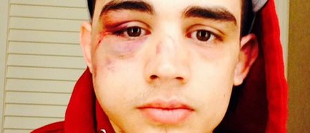 PICS: Ryan Benoit shows off horribly broken cheekbone sustained against Sergio Pettis