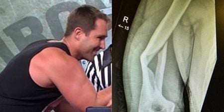 Ben Ross reveals horrifying results of snapping a bone in arm-wrestle [EXTREMELY GRAPHIC]