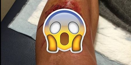 GRAPHIC: Spanish cyclist left staring at his bloody shin bone after disc brake accident