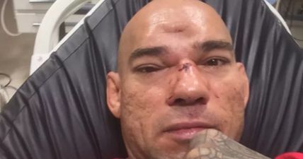 GRAPHIC: After seven-hour surgery, ‘Cyborg’ Santos shares photographs of his fractured skull