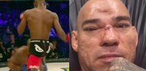 Six months after Michael Venom Page’s flying knee fractured his skull, Evangelista Santos retires