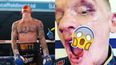 Boxer reveals the extent of horrific mouth injury suffered during fight