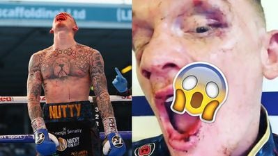 Boxer reveals the extent of horrific mouth injury suffered during fight